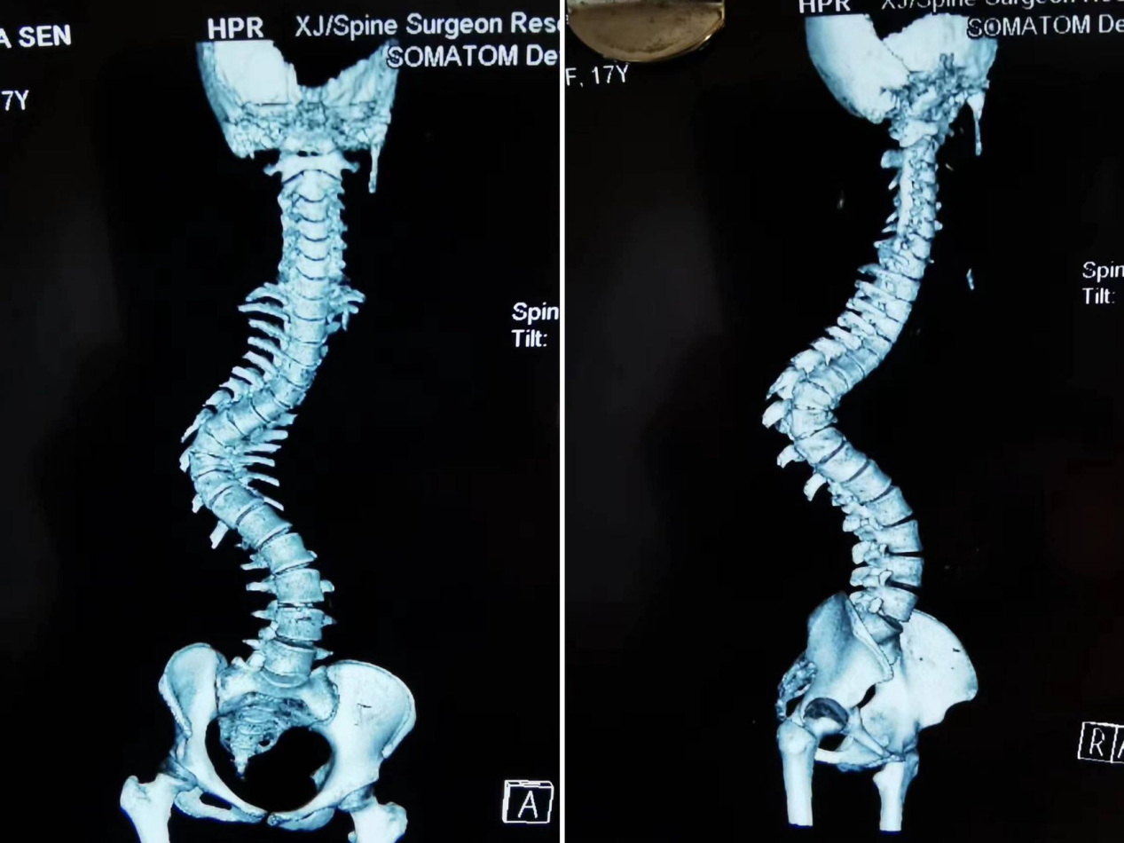 特发性脊柱侧凸后路截骨矫形内固定术