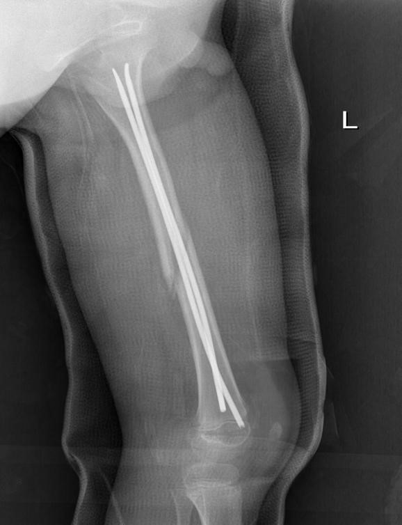 儿童四肢长管状骨骨折弹性髓内钉固定技术