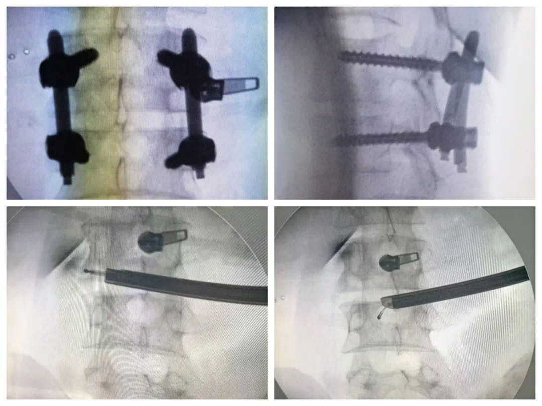 椎间孔镜下腰椎结核病灶清除＋椎间植骨融合＋经皮内固定术