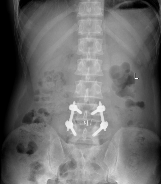 腰椎滑脱内镜下融合技术（Endo-LIF）