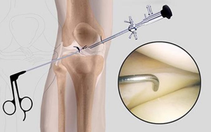 膝关节镜微创治疗膝关节损伤