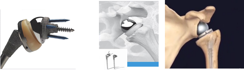 肩关节疾患的终极治疗方法-反置式肩关节置换术