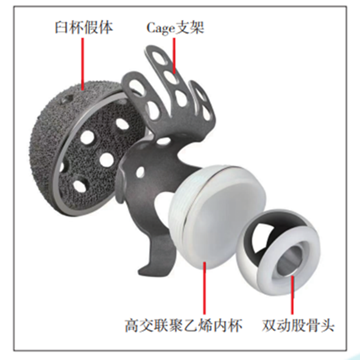 3D打印多孔钽金属在髋关节翻修重建髋臼骨质缺损中的应用