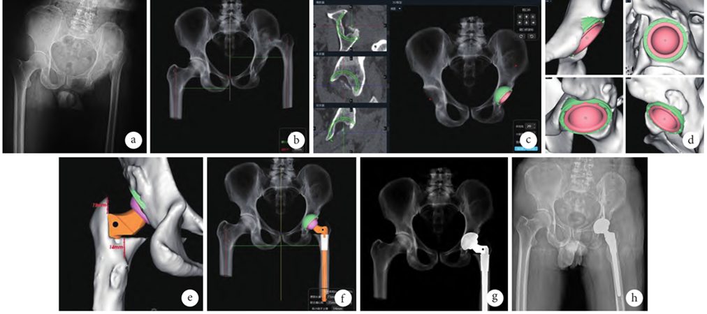 人工智能术前规划系统在人工全髋关节置换术治疗成人 发育性髋关节发育不良中的应用