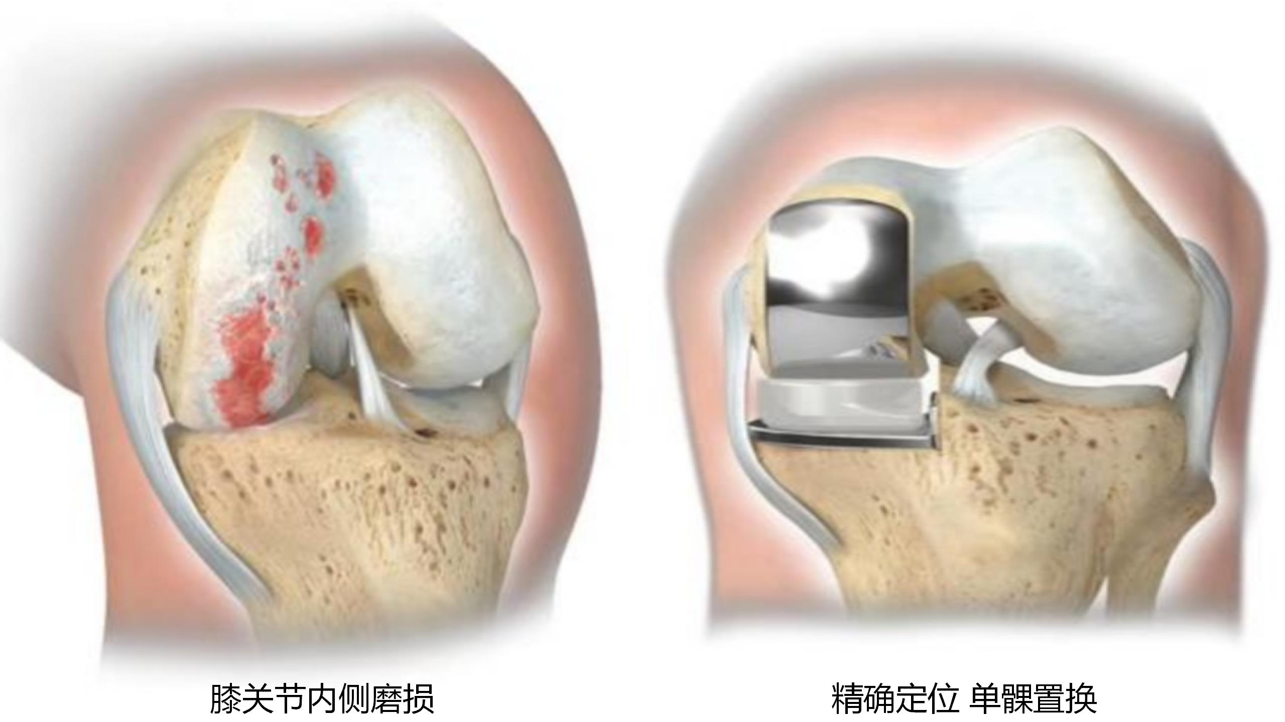 保留“膝”望,精准治疗您的膝关节!