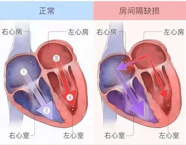 首例!新疆医科大学第六附属医院心血管内科成功开展房间隔缺损介入封堵术