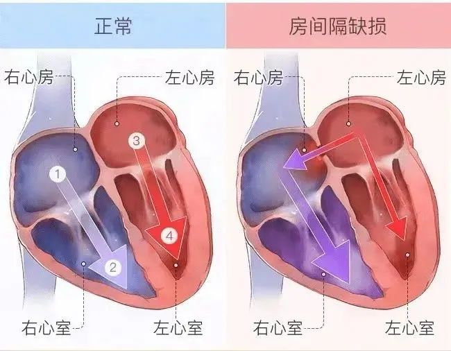 首例！新疆医科大学第六附属医院心血管内科成功开展房间隔缺损介入封堵术