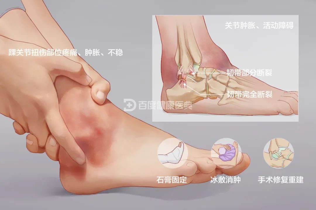 脚踝扭伤怎么办?这些康复手法请您收藏