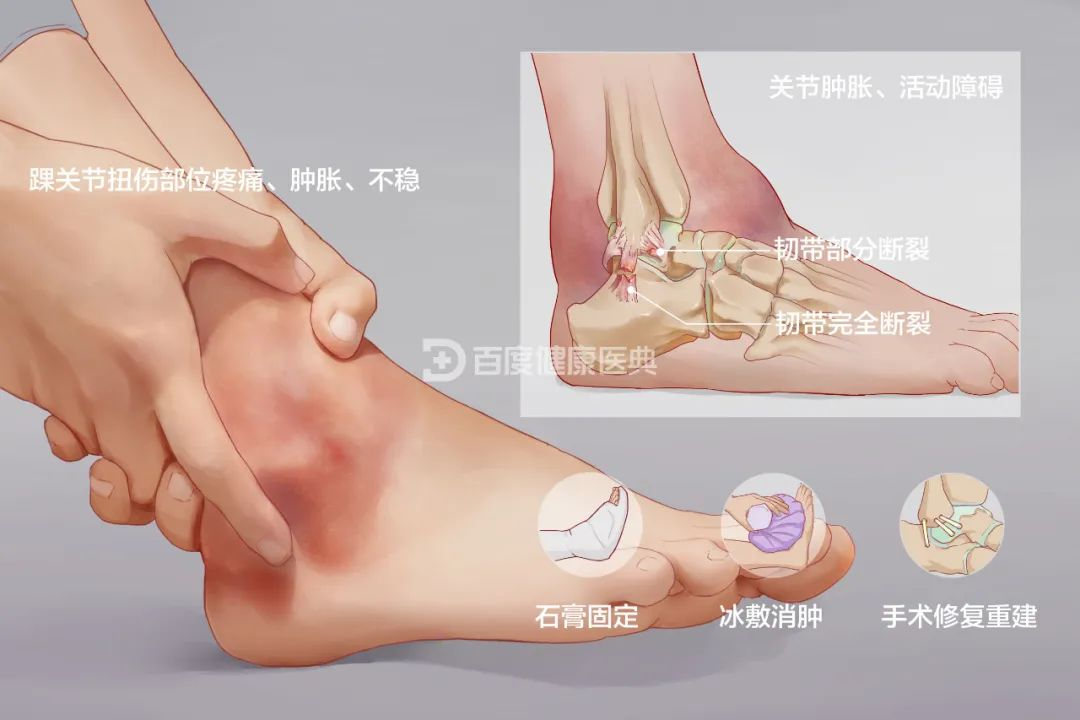 脚踝扭伤怎么办？这些康复手法请您收藏