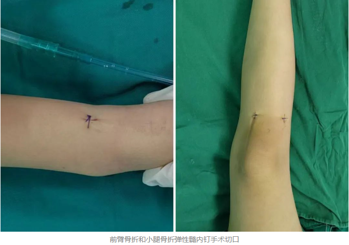 【特色诊疗】专注小儿骨科,用心护航儿童骨骼健康 !