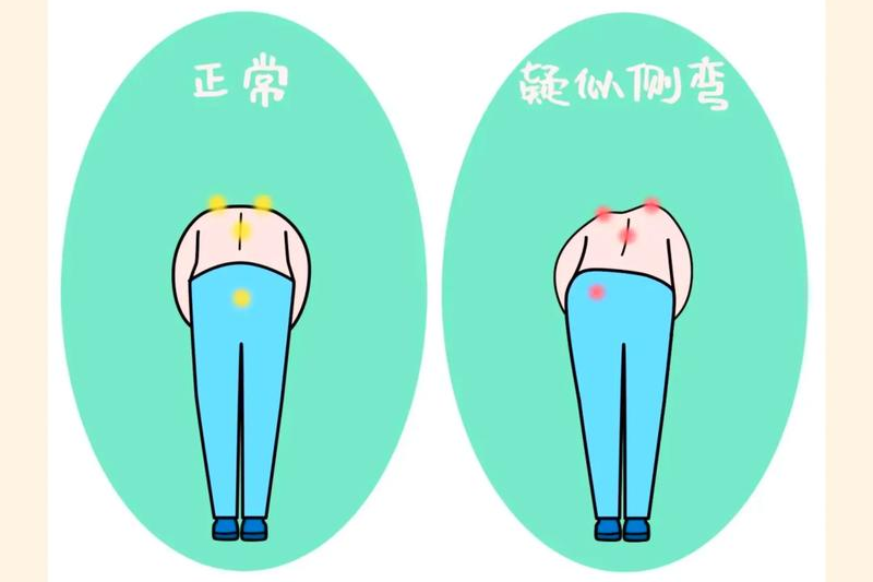 孩子背有点“歪”？别等！10-14岁是脊柱侧弯黄金发现期，家长能做这3件事
