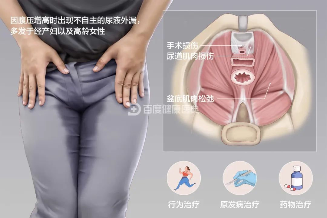 打喷嚏就漏尿？“社交癌”困扰50+女性 自体筋膜悬吊手术助其重拾自信