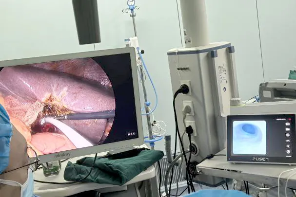 我院普外科成功实施高难度经胆囊管胆总管取石术